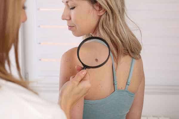 What Are Traditional Skin Lesion Removal Methods Cambridgeshire?