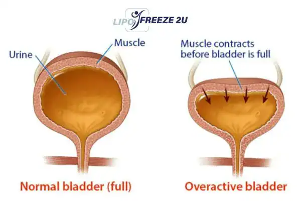 diagram of overactive bladder treatment Cambridgeshire