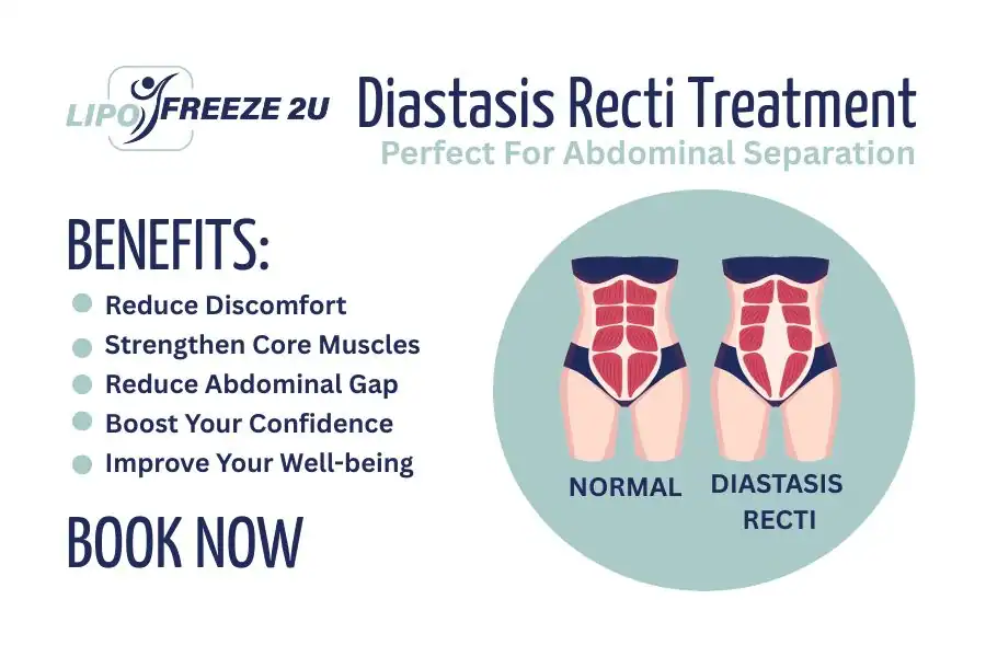 Benefits of body toning treatment Cambridgeshire for Diastasis recti