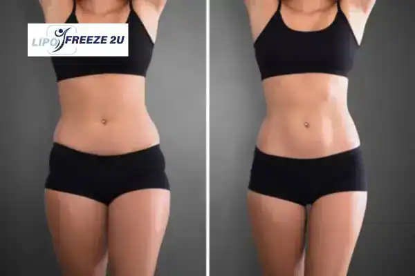 How Can LIPO FREEZE 2U Support Your Post-Pregnancy Body Recovery Cambridgeshire?