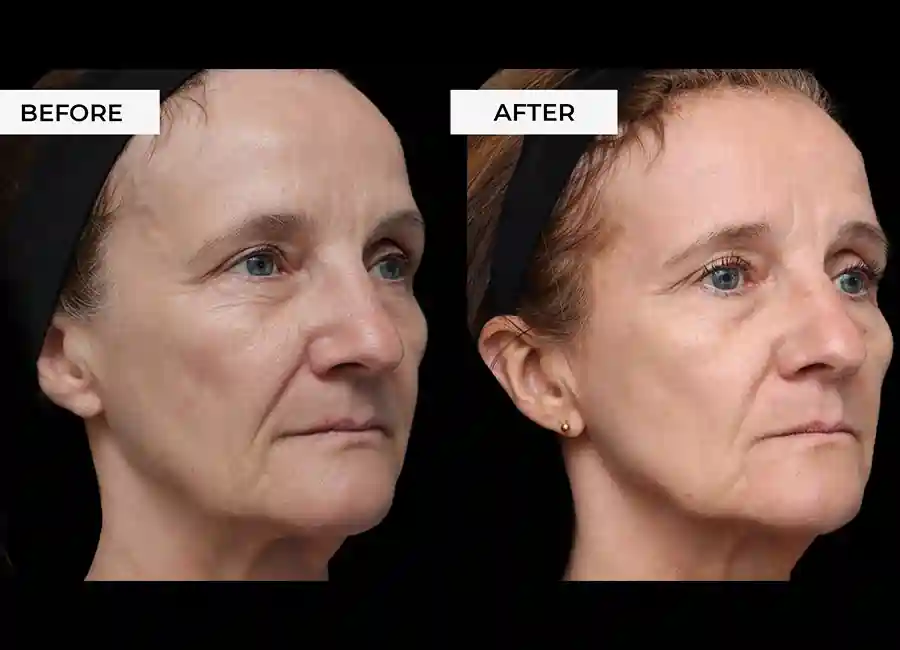 How Many RF Microneedling Sessions Will You Need to See a Difference Cambridgeshire?