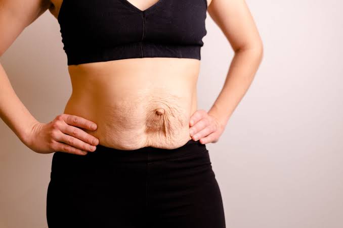 Is Surgery Really the Only Way to Repair Diastasis Recti Cambridgeshire?