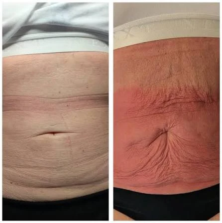 How Does RF Microneedling Improve Crepey, Thin and Uneven Skin Texture Cambridgeshire?