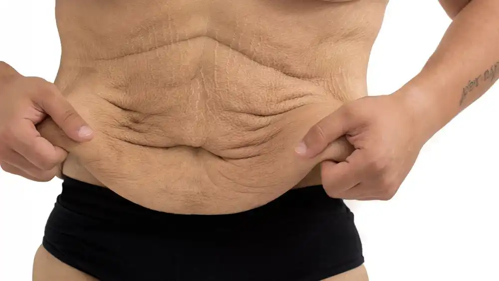 Why Does Weight Loss Medication Leave Some People With Loose or Sagging Skin Cambridgeshire?